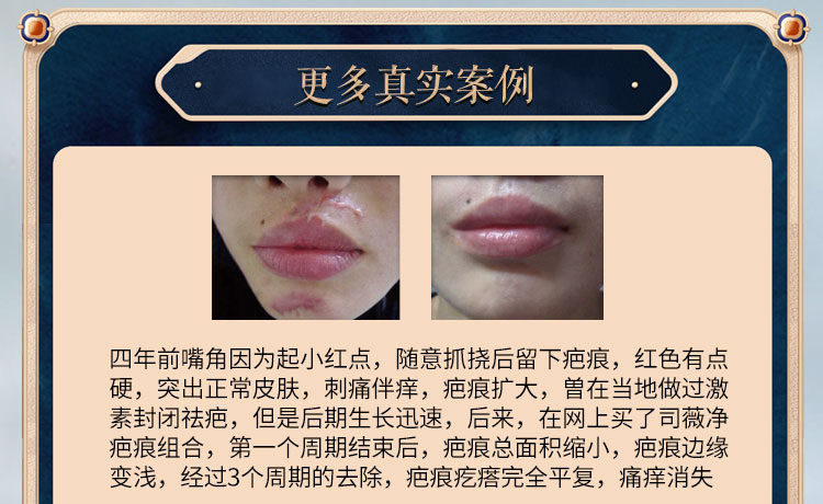swlch祛疤膏备案